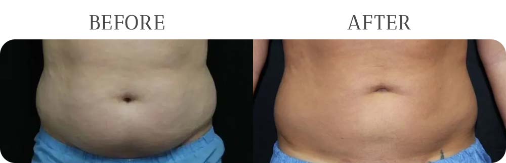 BodyTite Treatment Results at Vermont Medspa in Los Angeles, CA