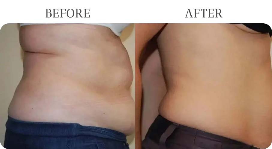 BodyTite Treatment Results at Vermont Medspa in Los Angeles, CA
