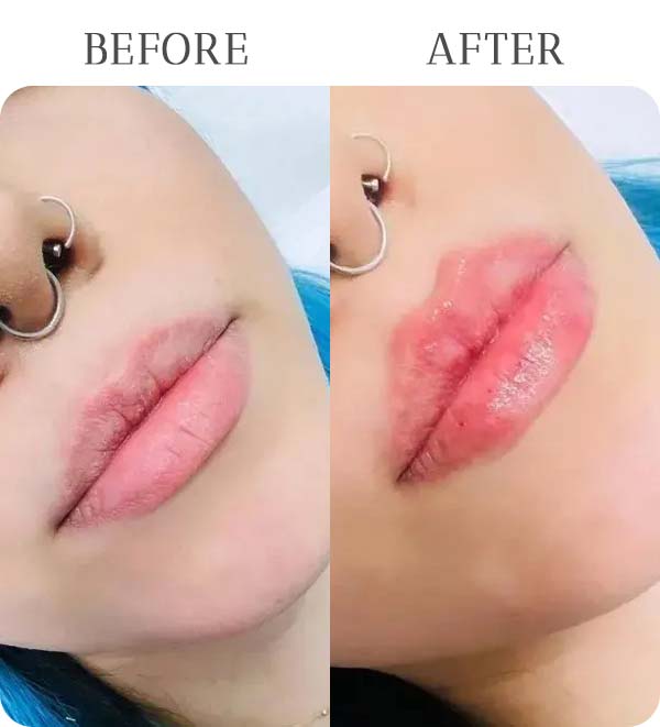 Lip Filler Treatment Results at Vermont Medspa in Los Angeles, CA