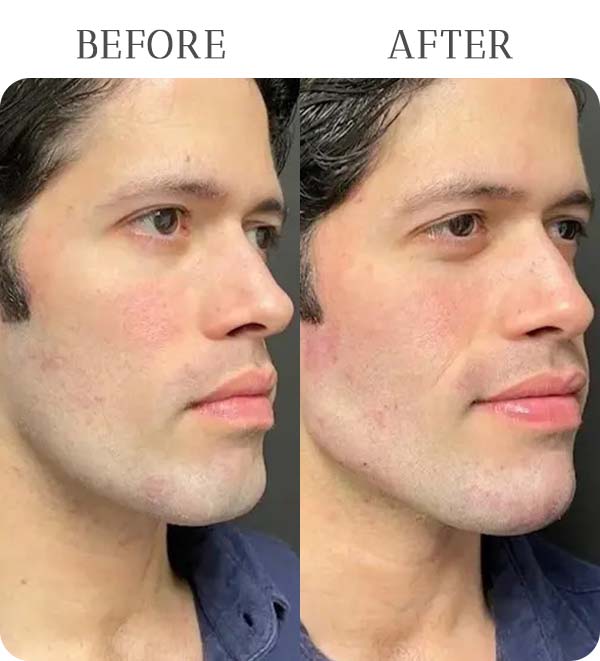 Jawline Filler Treatment Results at Vermont Medspa in Los Angeles, CA
