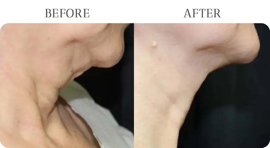 FaceTite Treatment Results at Vermont Medspa in Los Angeles, CA