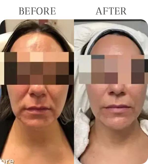 Morpheus 8 Treatment Results at Vermont Medspa in Los Angeles, CA
