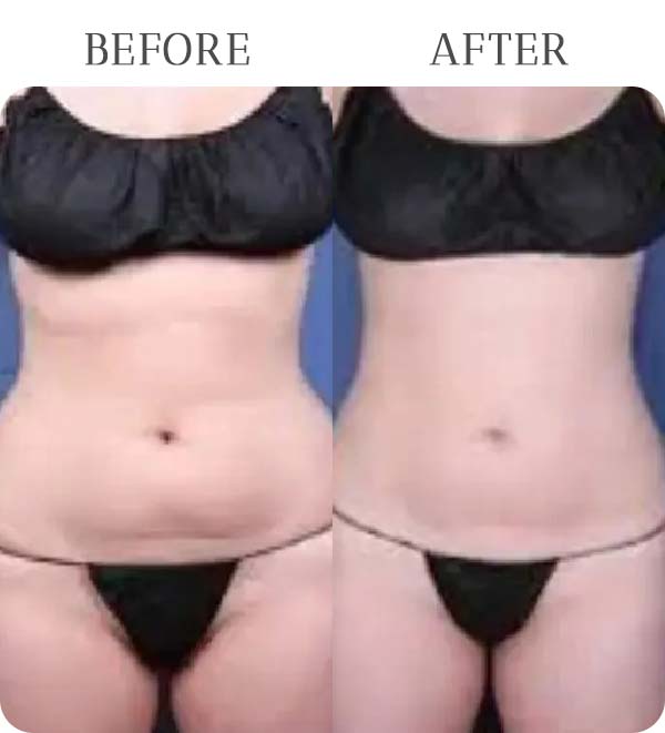 BodyTite Treatment Results at Vermont Medspa in Los Angeles, CA