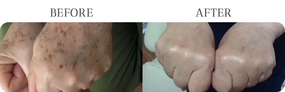 IPL Treatment Results at Vermont Medspa in Los Angeles, CA