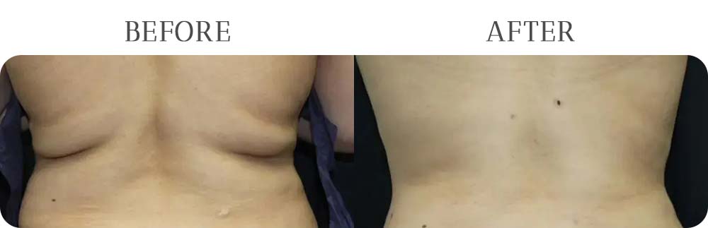 BodyTite Treatment Results at Vermont Medspa in Los Angeles, CA