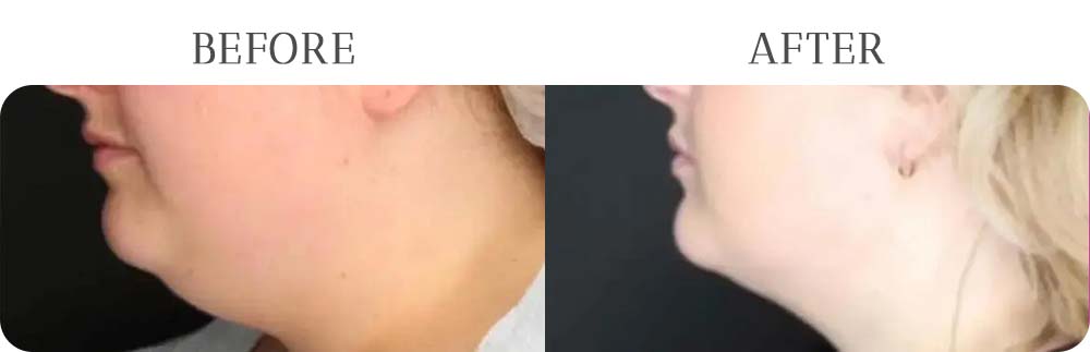 FaceTite Treatment Results at Vermont Medspa in Los Angeles, CA