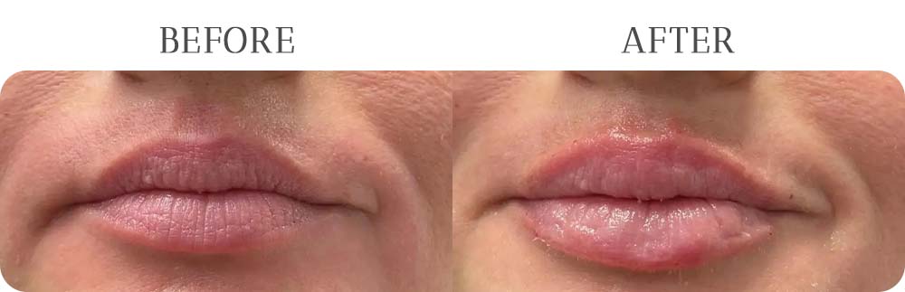 Lip Filler Treatment Results at Vermont Medspa in Los Angeles, CA