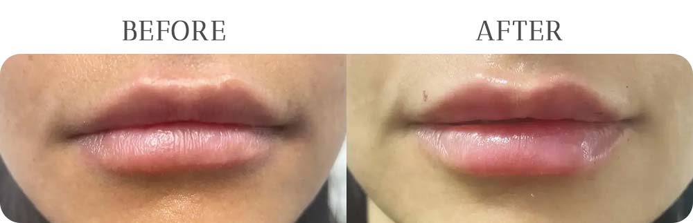 Lip Filler Treatment Results at Vermont Medspa in Los Angeles, CA