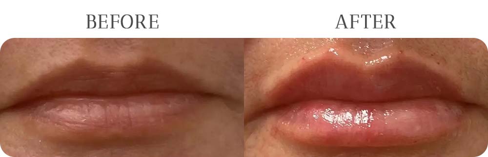 Lip Filler Treatment Results at Vermont Medspa in Los Angeles, CA