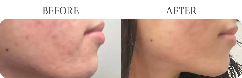 Morpheus 8 Treatment Results at Vermont Medspa in Los Angeles, CA