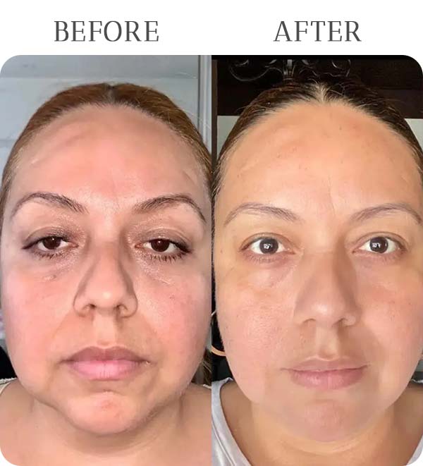 Morpheus 8 Treatment Results at Vermont Medspa in Los Angeles, CA