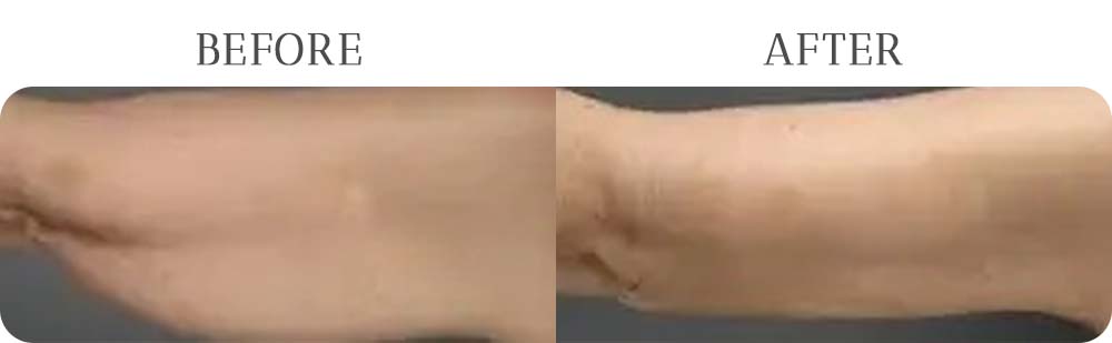 BodyTite™ Treatment Results at Vermont Medspa in Los Angeles, CA
