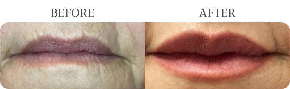 Lip Boost Treatment Results at Vermont Medspa in Los Angeles, CA