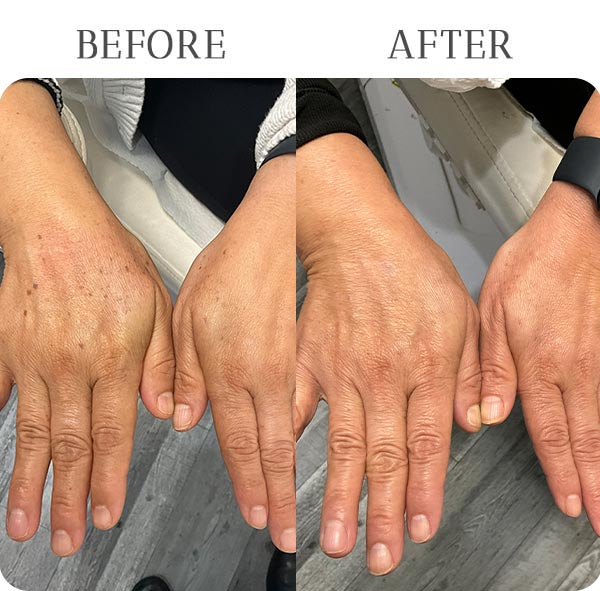 Lumecca Treatment Results at Vermont Medspa in Los Angeles, CA Lumecca Treatment Results at Vermont Medspa in Los Angeles, CA