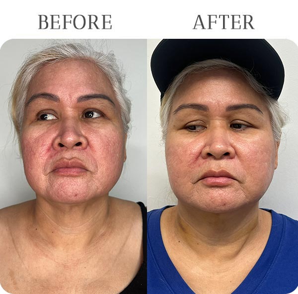 EndoLift Treatment Results at Vermont Medspa in Los Angeles, CA EndoLift Treatment Results at Vermont Medspa in Los Angeles, CA