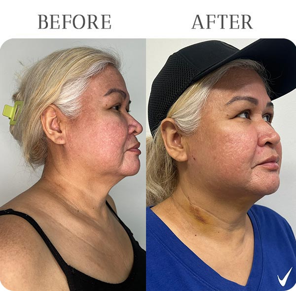 EndoLift Treatment Results at Vermont Medspa in Los Angeles, CA EndoLift Treatment Results at Vermont Medspa in Los Angeles, CA