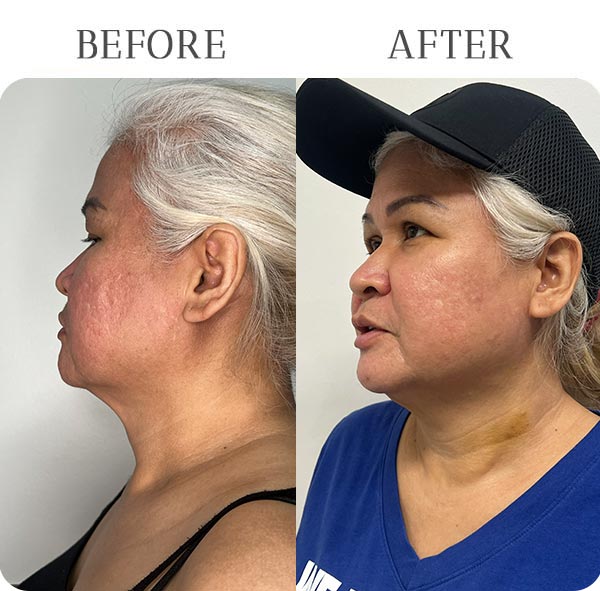 EndoLift Treatment Results at Vermont Medspa in Los Angeles, CA EndoLift Treatment Results at Vermont Medspa in Los Angeles, CA