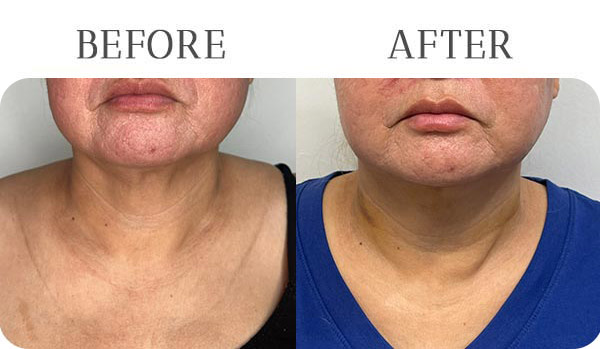 EndoLift Treatment Results at Vermont Med Spa in Los Angeles, CA EndoLift Treatment Results at Vermont Med Spa in Los Angeles, CA