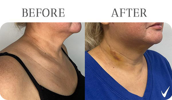 EndoLift Treatment Results at Vermont Med Spa in Los Angeles, CA EndoLift Treatment Results at Vermont Med Spa in Los Angeles, CA