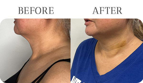 EndoLift Treatment Results at Vermont Med Spa in Los Angeles, CA EndoLift Treatment Results at Vermont Med Spa in Los Angeles, CA